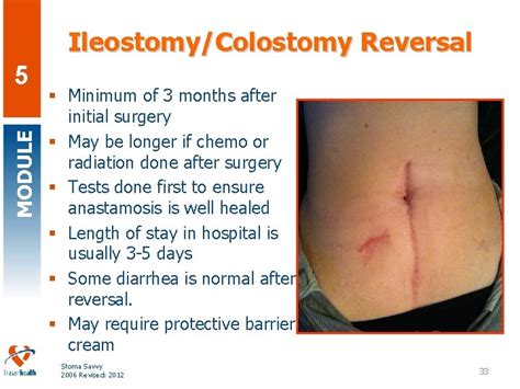 Reversal Of A Stoma