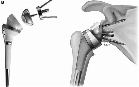 Reverse Shoulder Rehab Guide: Full Recovery