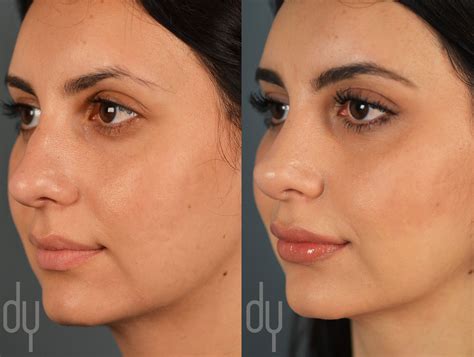 Rhinoplasty Before After Photos Beverly Hills La Rhinoplasty