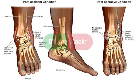 Right Foot Injuries With Subsequent Conditions Doctor Stock