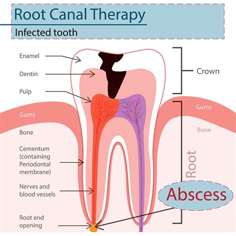 Root Canal Therapy Tooth Extraction Woodinville Wa Restorative