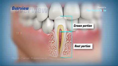 Root Canal Video Tooth Decay Treatment Video Dental Video Library