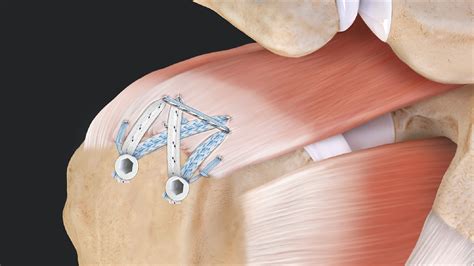 Rotator Cuff Repair: Full Mobility Guide