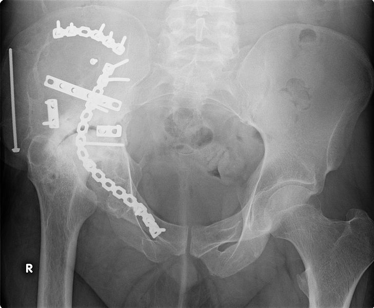 Sacral Bone Fracture