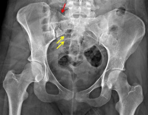 Sacrum Bone Broken