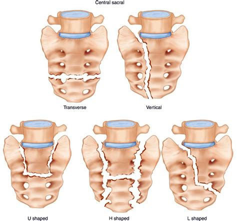 Sacrum Fracture