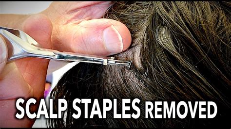 Scalp Staples Removal: Heal Faster