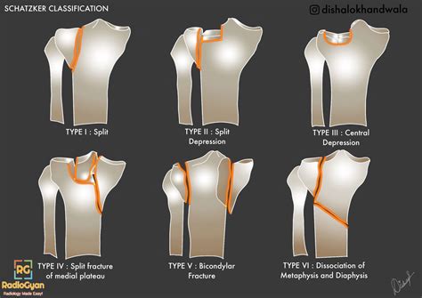 Schatzker Classification Of Tibial Plateau Fractures Radiogyan