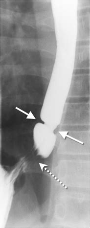 Schatzki Ring In Pediatric And Young Adult Patients Springerlink