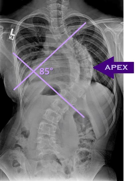 Scoliosis X Ray Cobb Angle