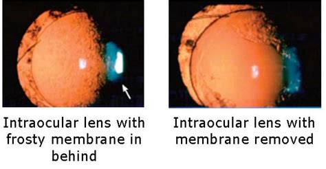 Secondary Cataracts Anderson Eye Surgery