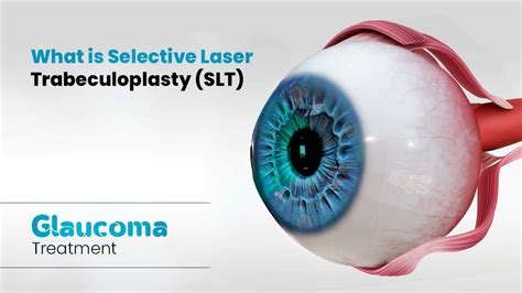 Selective Laser Trabeculoplasty Slt For Glaucoma Youtube