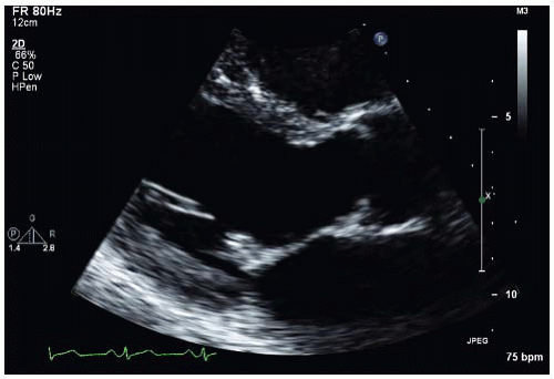 Shortness Of Breath And Dyspnea On Exertion Thoracic Key