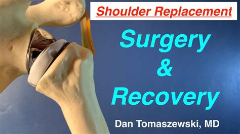 Shoulder Replacement Recovery