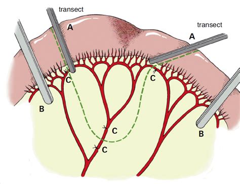 Small Intestinal Resection Anastomosis Clinician S Brief