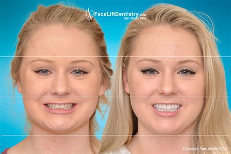 Small Teeth Chin Overbite Fix No Drill No Clear Aligners