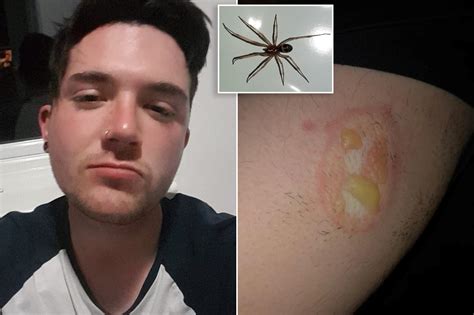 Spider Leaves Man With Flesh Eating Wound That Won T Heal