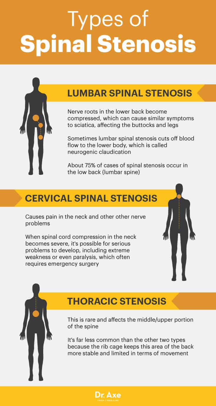 Spinal Migraine Symptoms