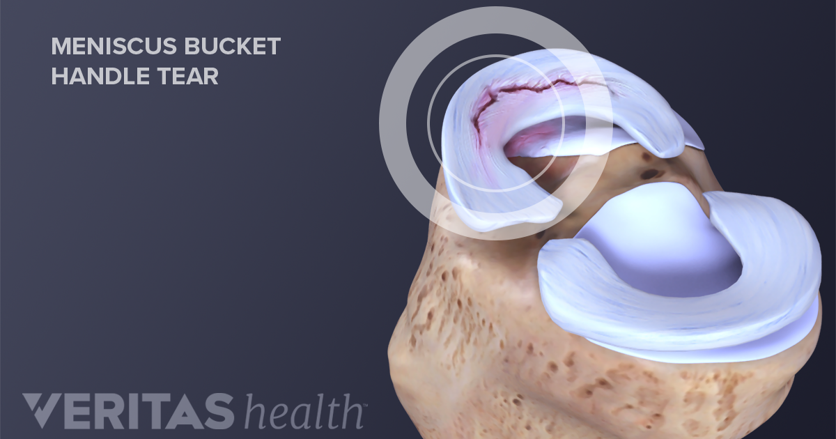 Sports Injuries Of The Knee Acl And Meniscus Tears Summa Health