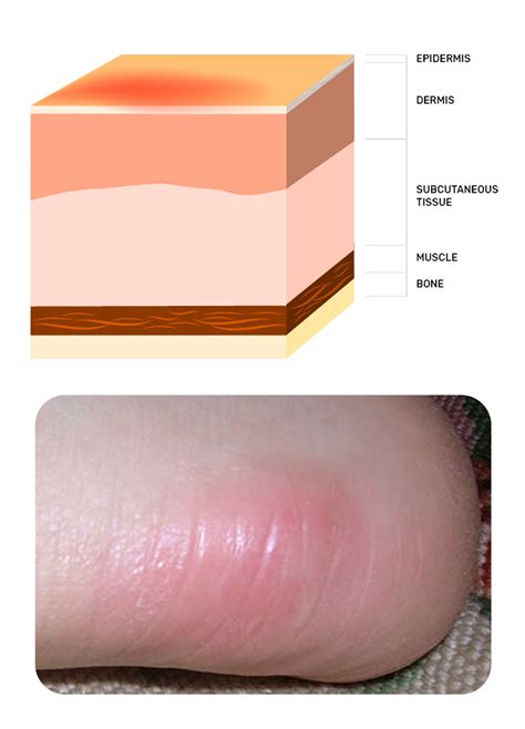 Stage 1 Pressure Injuries A Non Blanchable Red Area To Coccyx Or