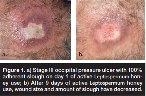 Stage Iii Occipital Pressure Ulcer With 100% Adherent Slough On Days 1 ...