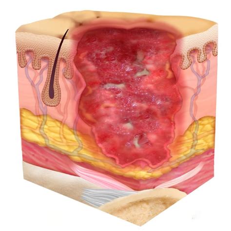 Stage Three Pressure Injury