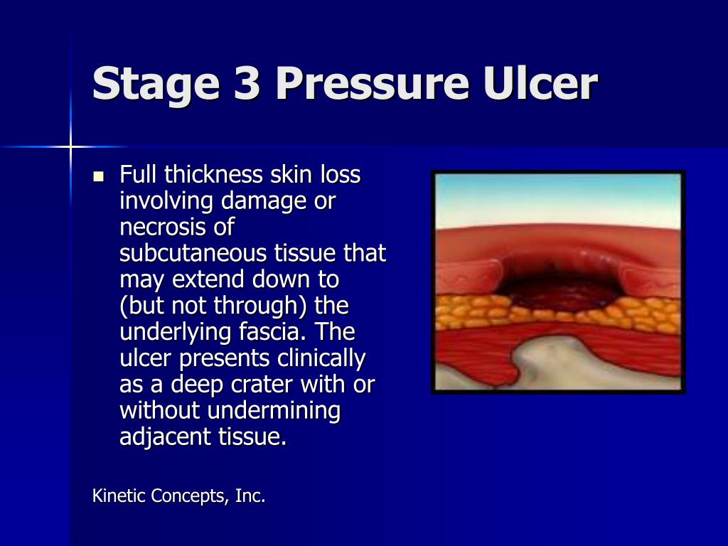 Stage Three Pressure Ulcer