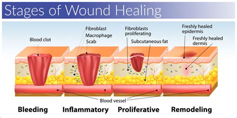 Stage Three Wound: Healing And Recovery Tips