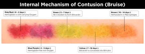 Stages Of Bruising Colors Pictures Chart And Different Bruise Healing