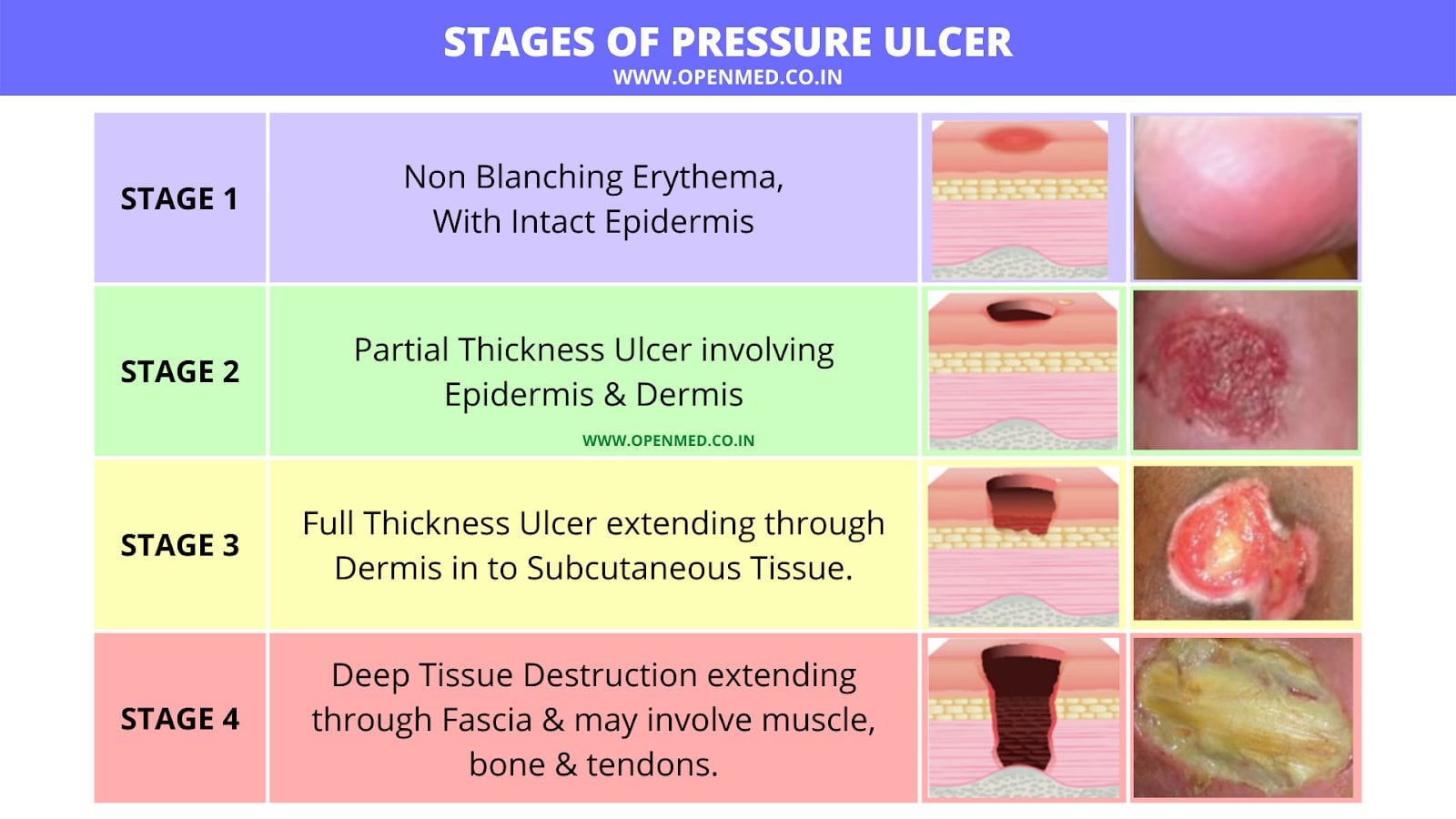 Stages Of Pressure Ulcer R Foamed