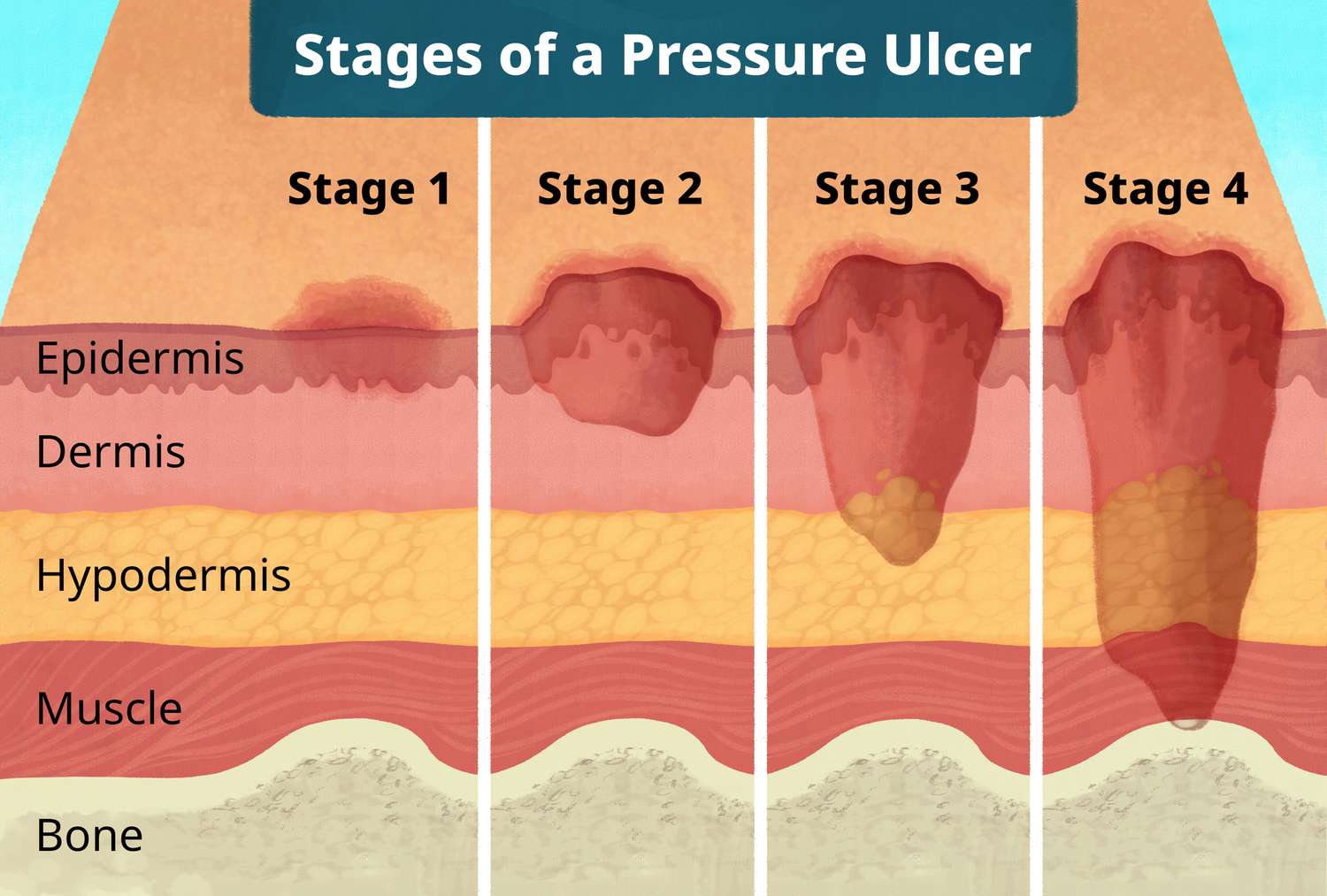 Stages Of Pressure Ulcers Sore Stages And Treatments