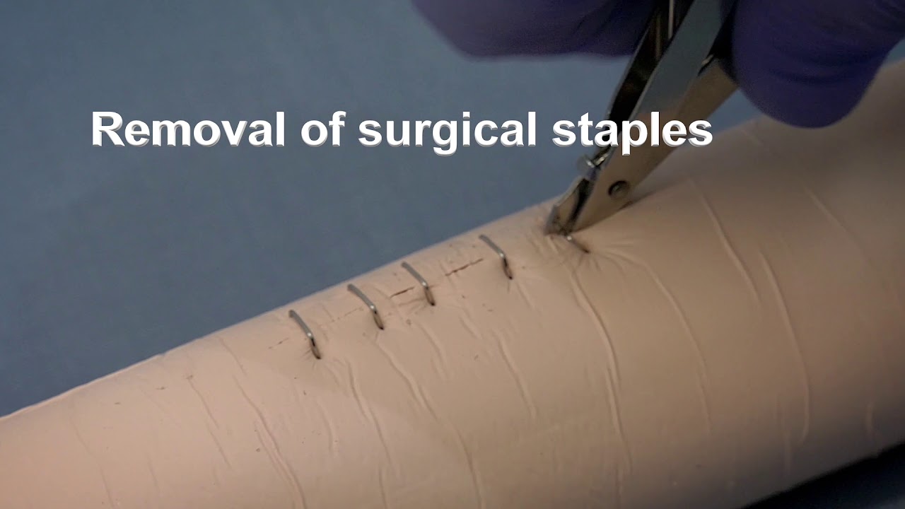 Staples To Scalp Laceration Nazarian Plastic Surgery Youtube