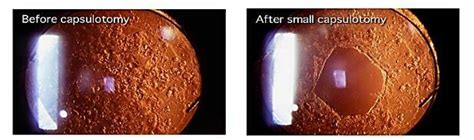 Status Post Yag Laser Treatment