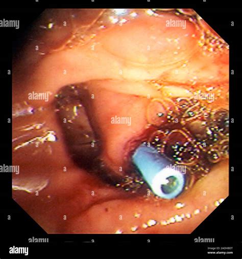 Stent In Bile Duct