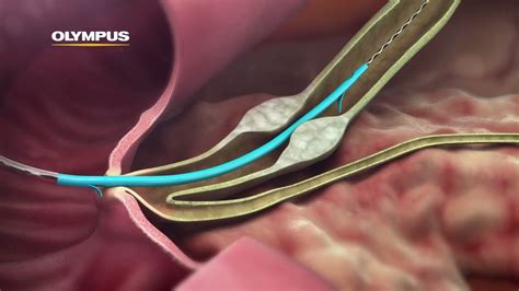 Stent In Biliary Duct