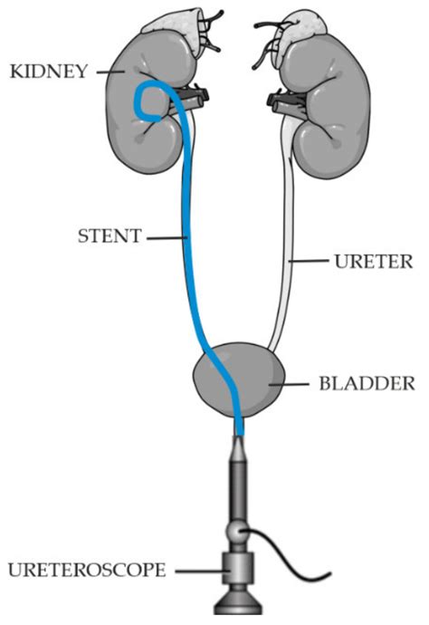 Stent In The Bladder