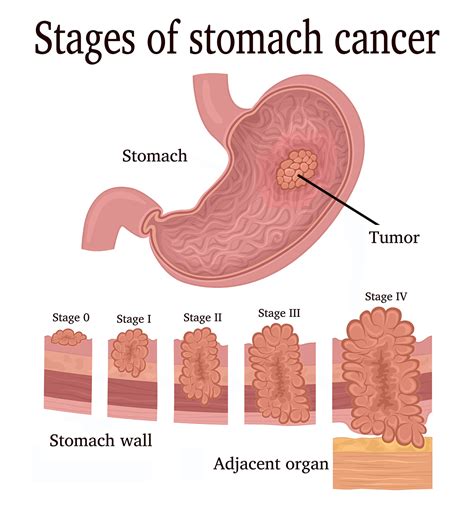 Stomach Cancer Saint John S Cancer Institute