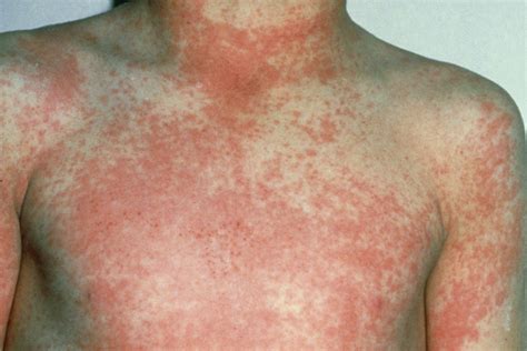 Strep Rash Scarlatina Rash Viral Strep Throat Rash