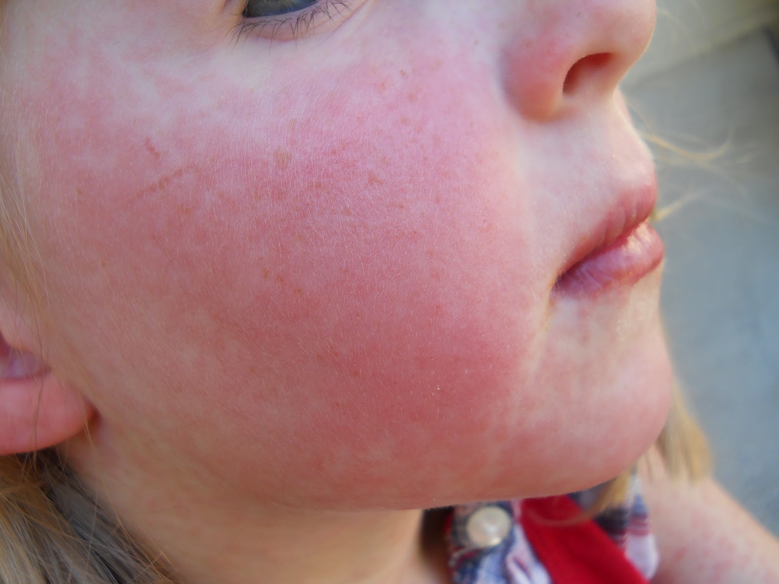 Streptococcal Nappy Rash