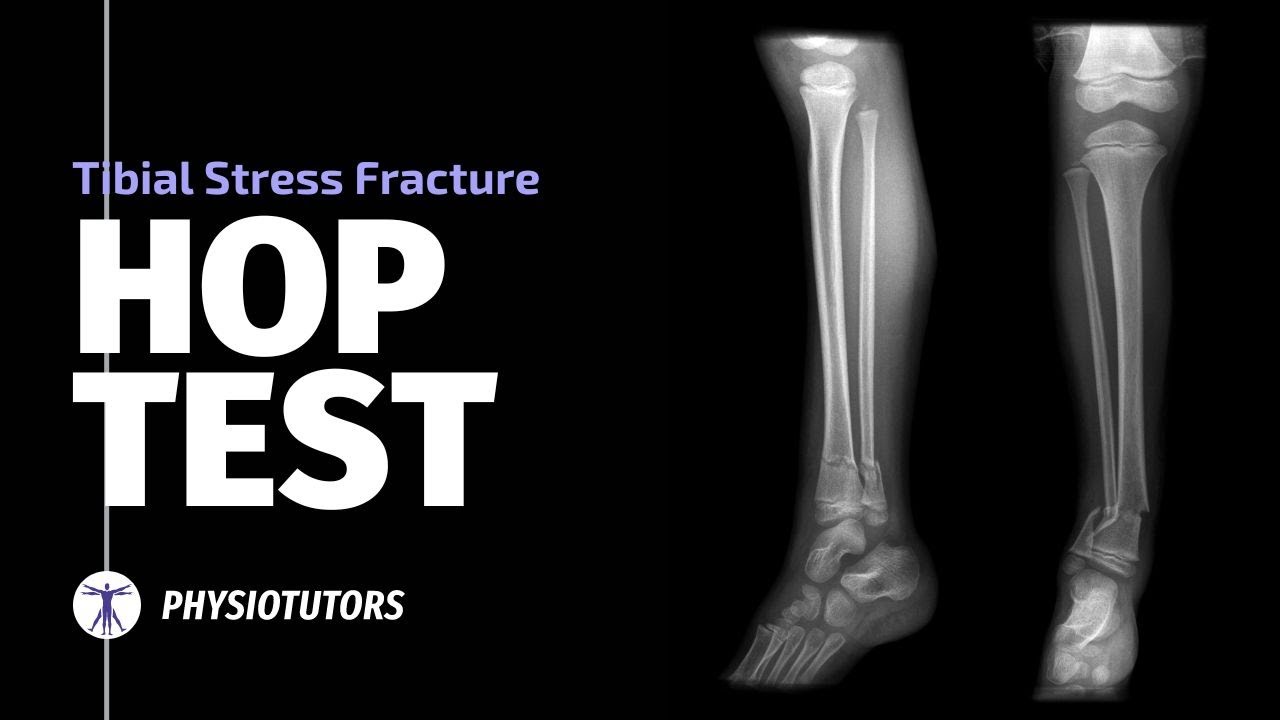 Stress Fracture Leg Healing Tips