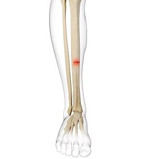 Stress Fracture Of The Tibia Birmingham Al Patella Fracture