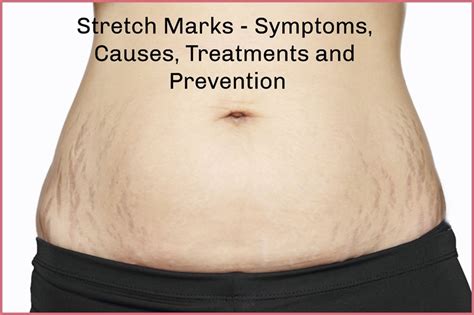 Stretch Marks Explained Causes Prevention And Treatments