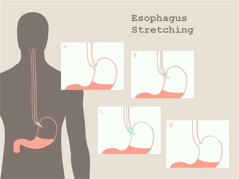 Stretching Of Esophagus