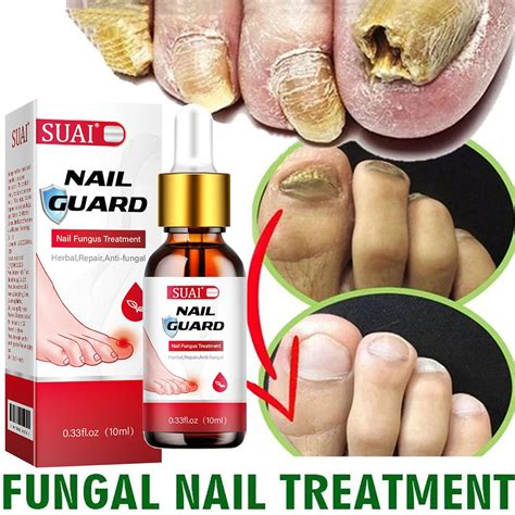 Suai Nail Fungus Treatment Feet Care Serum Fungal Nail Treatment For