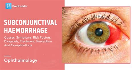 Subconjunctival Hemorrhage: Heal Quickly At Home