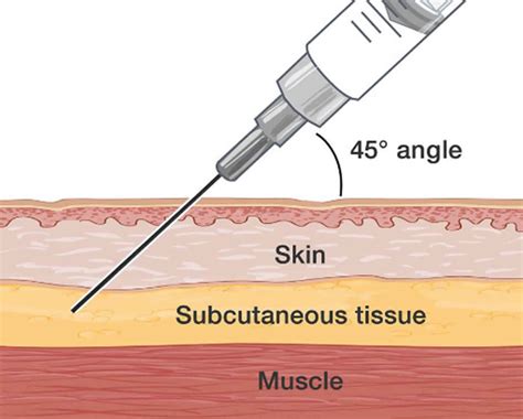 Subcutaneous Injection Sites