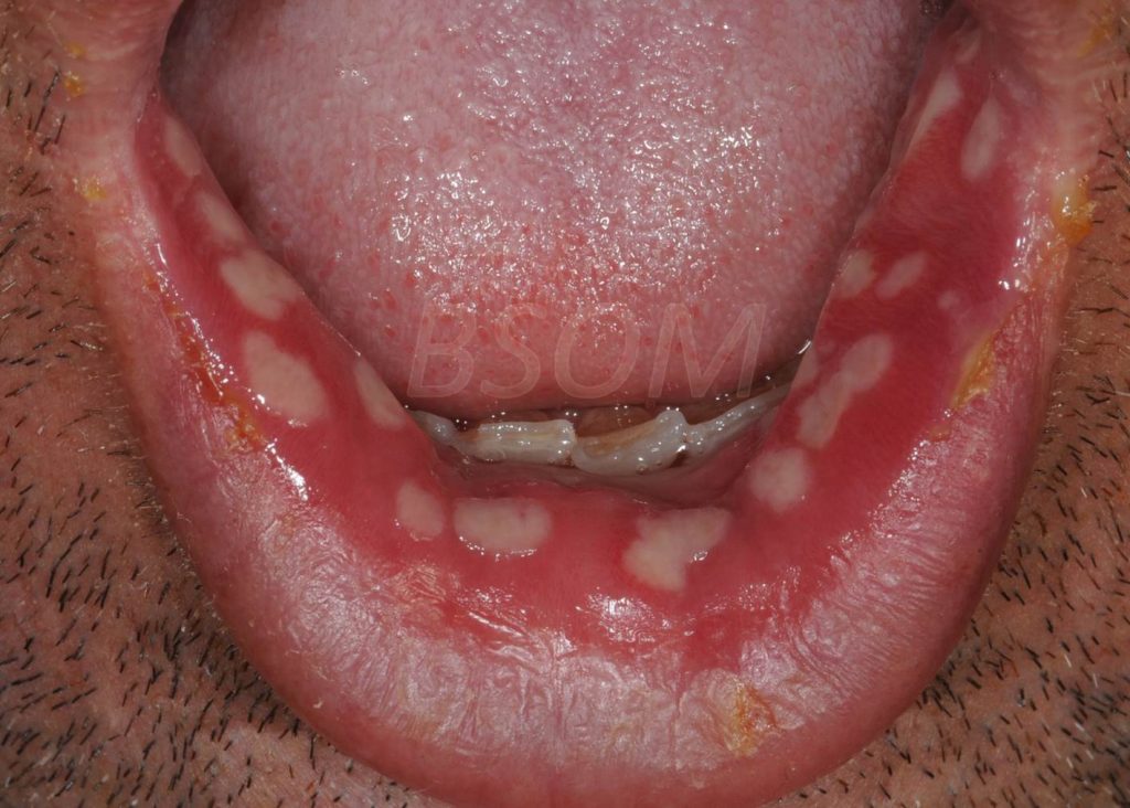 Sudden Onset Painful Mouth Ulcers Herpes British Amp Irish Society