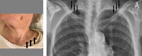 Supraclavicular Lymph Nodes Swollen Left Side Pointstorm