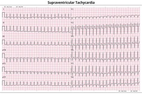 Supraventricular Tachycardia: Manage Symptoms Naturally