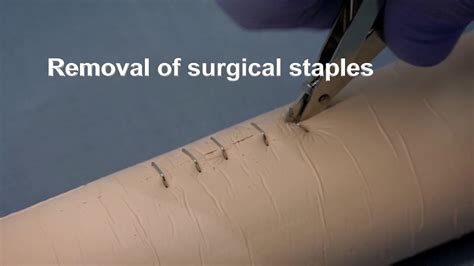 Surgical Staples Removal Pain